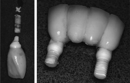 牙科氧化锆种植体断裂失效分析